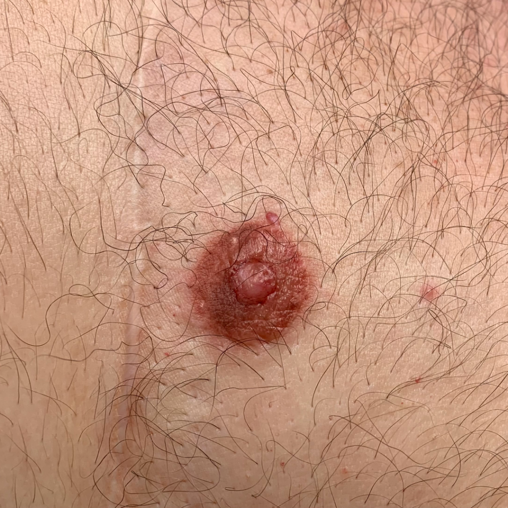 Areola 3_AFTER