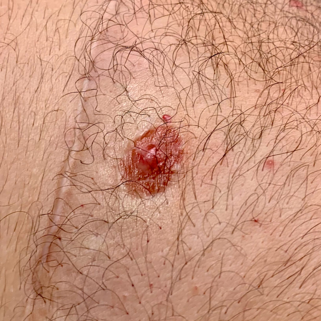 Areola 3_BEFORE