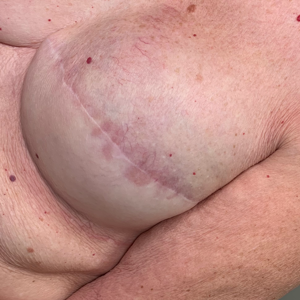 Areola1_BEFORE