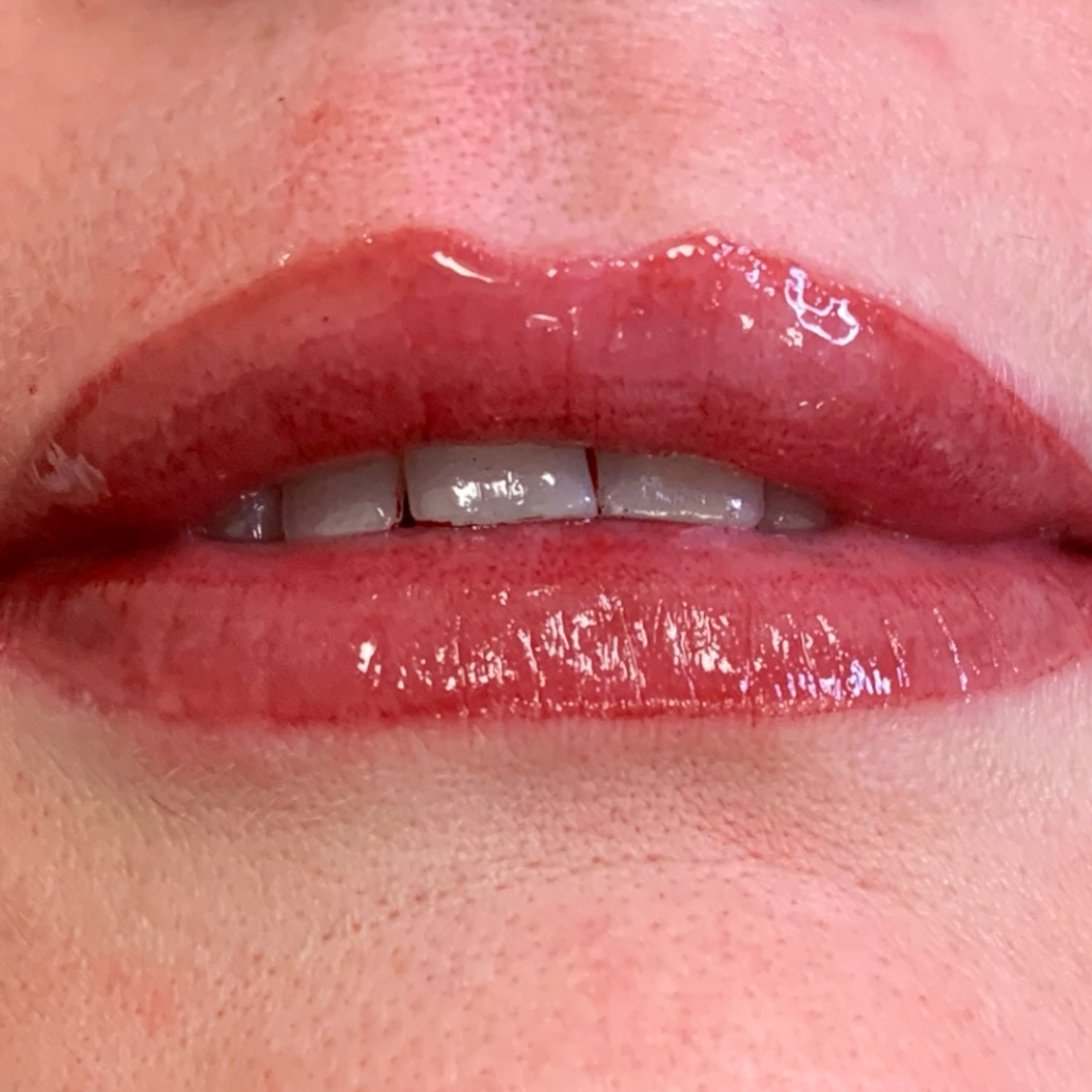 CleftLip_AFTER1