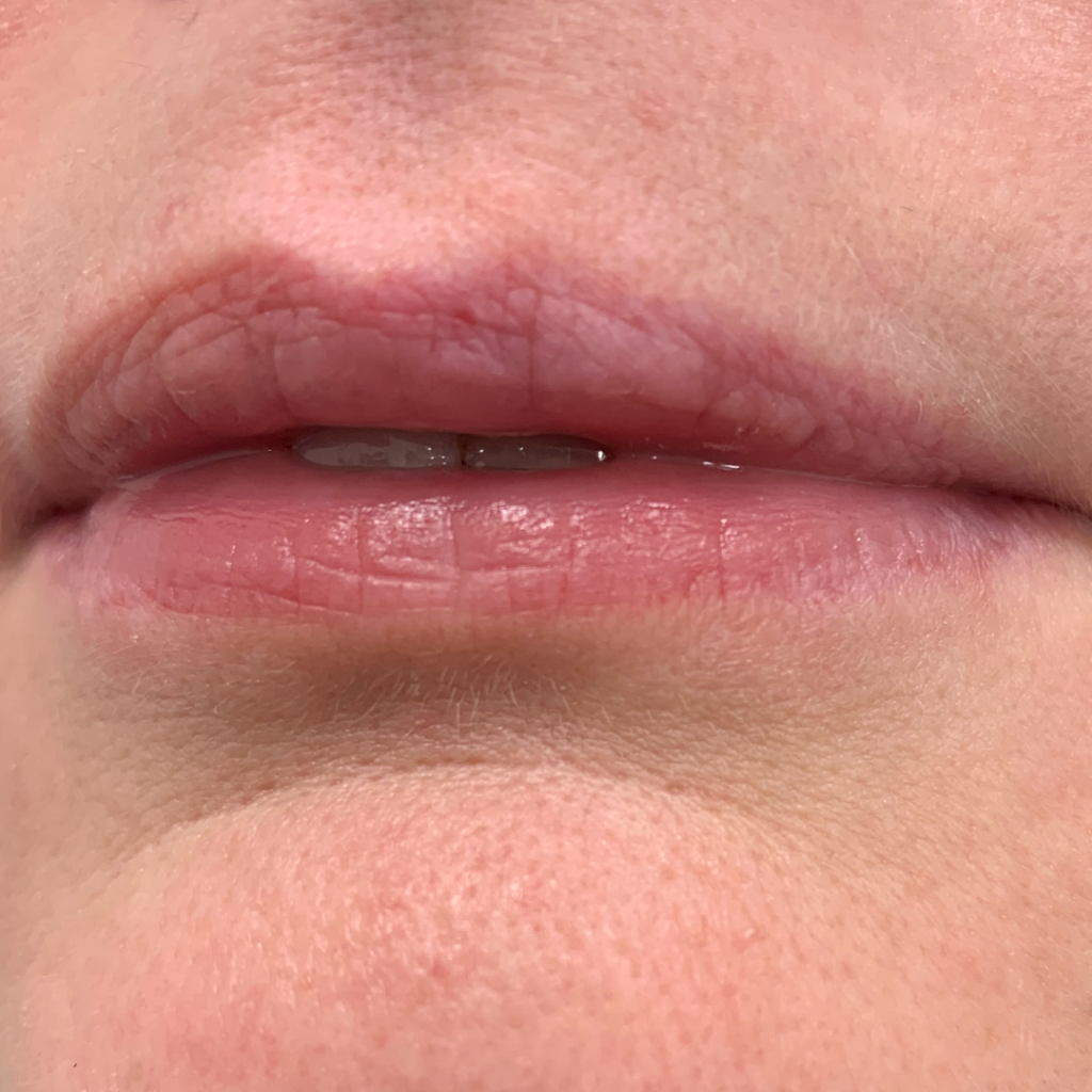 CleftLip_BEFORE1