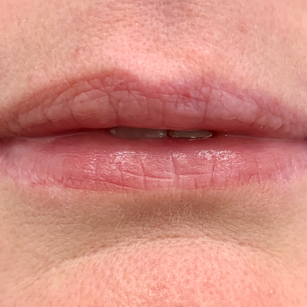 CleftLip_BEFORE2