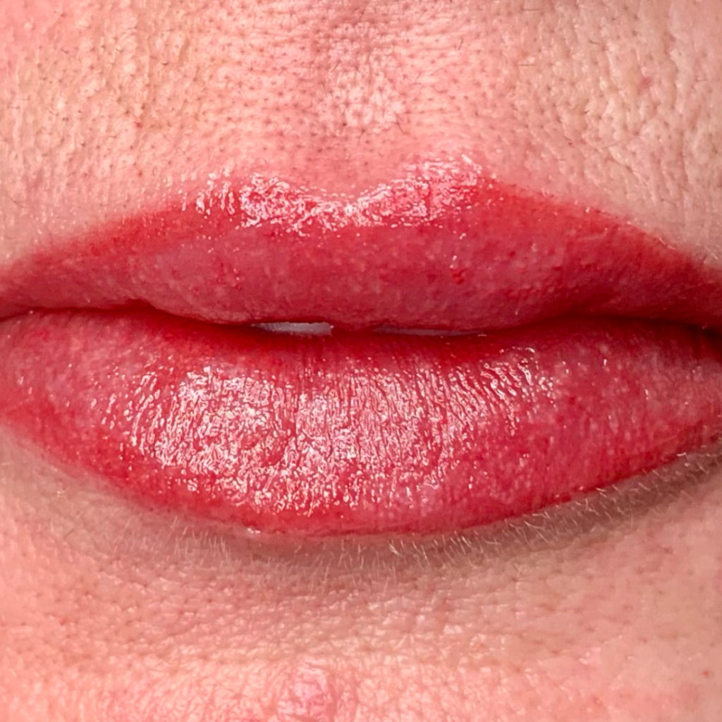 Lip Asym_AFTER
